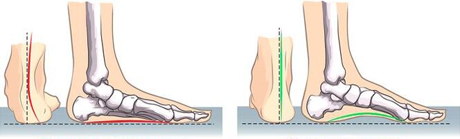 Flat valgus and normal feet