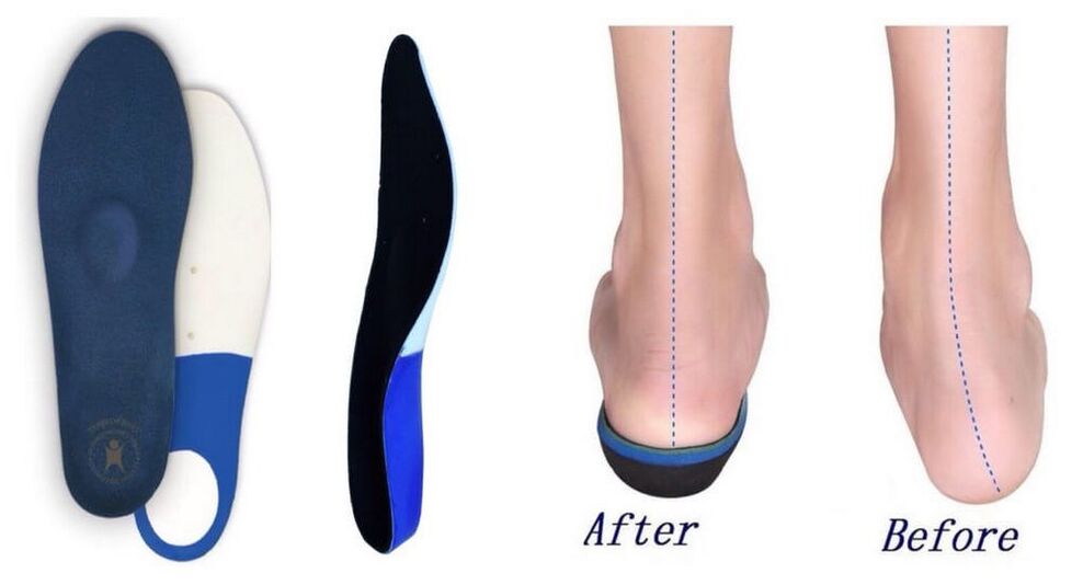 Orthopedic insoles for plano-valgus foot deformities