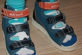wearing sandals for hallux valgus in children