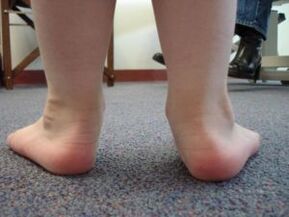 Flat valgus foot deformity in children