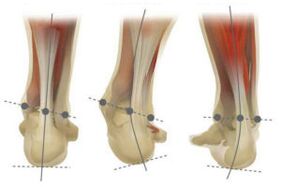 Normal foot, with valgus deviation and varus calcaneus