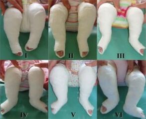 Plastering procedures, each of which changes the position of the legs