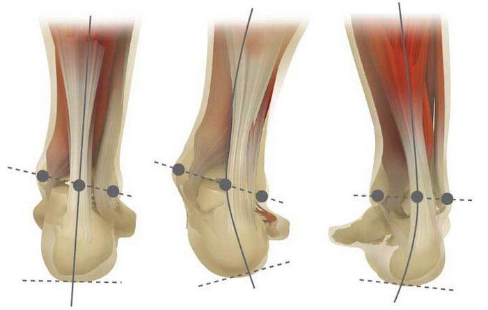 Kind of valgus