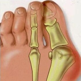 Reason for Valgus