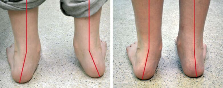 The legs of valgus