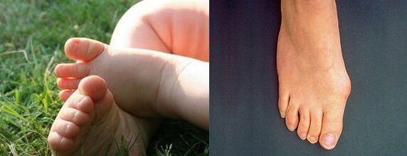 Deformed the first leg valgus of the foot