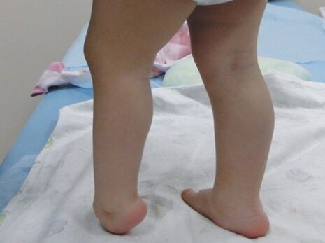 The first symptom of deforming the leg valgus