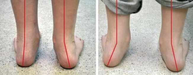 The legs of valgus