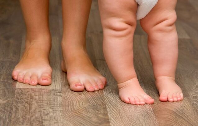 Valgus foot deformation on children