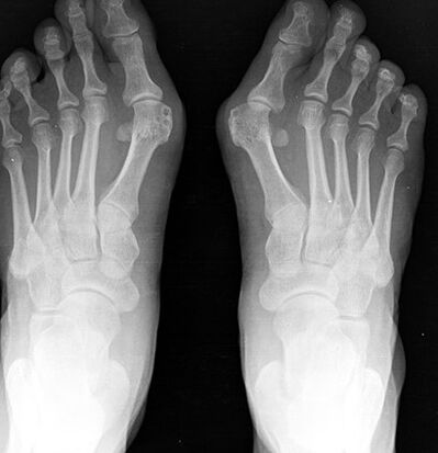 X -ray leg
