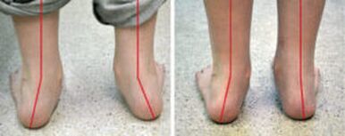 The curvature of valgus
